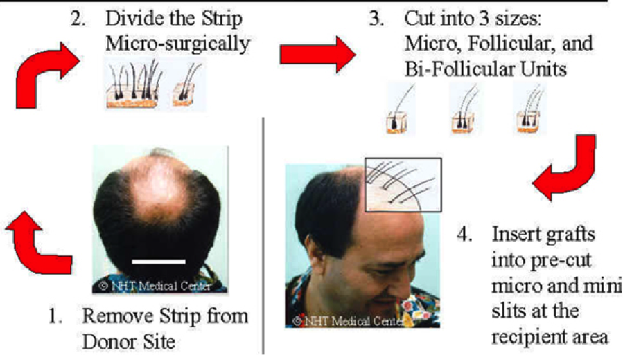 hair transplant india8186 - fut | fue adorn